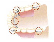 部分入れ歯